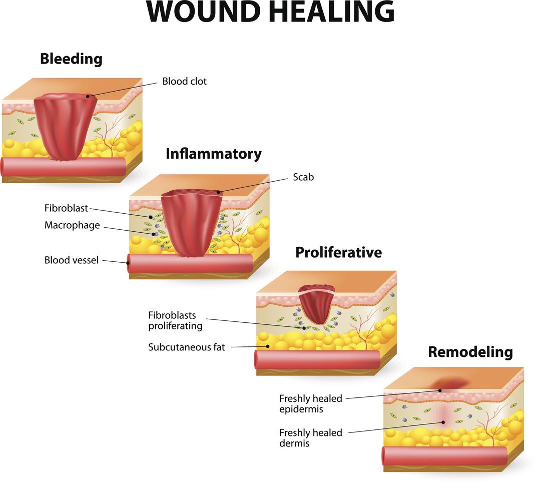 The four phases of  wound healing post hernia surgery.