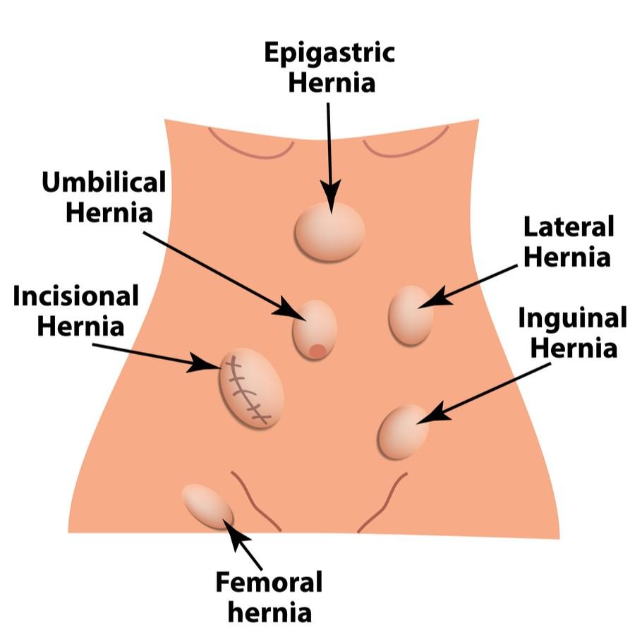 What is a hernia? Illustration of the different types of abdominal wall hernias and where they are located, including ventral hernias and groin hernias.