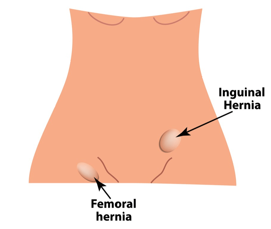 Illustration of the different types of groin hernias and where on the abdomen they are located.