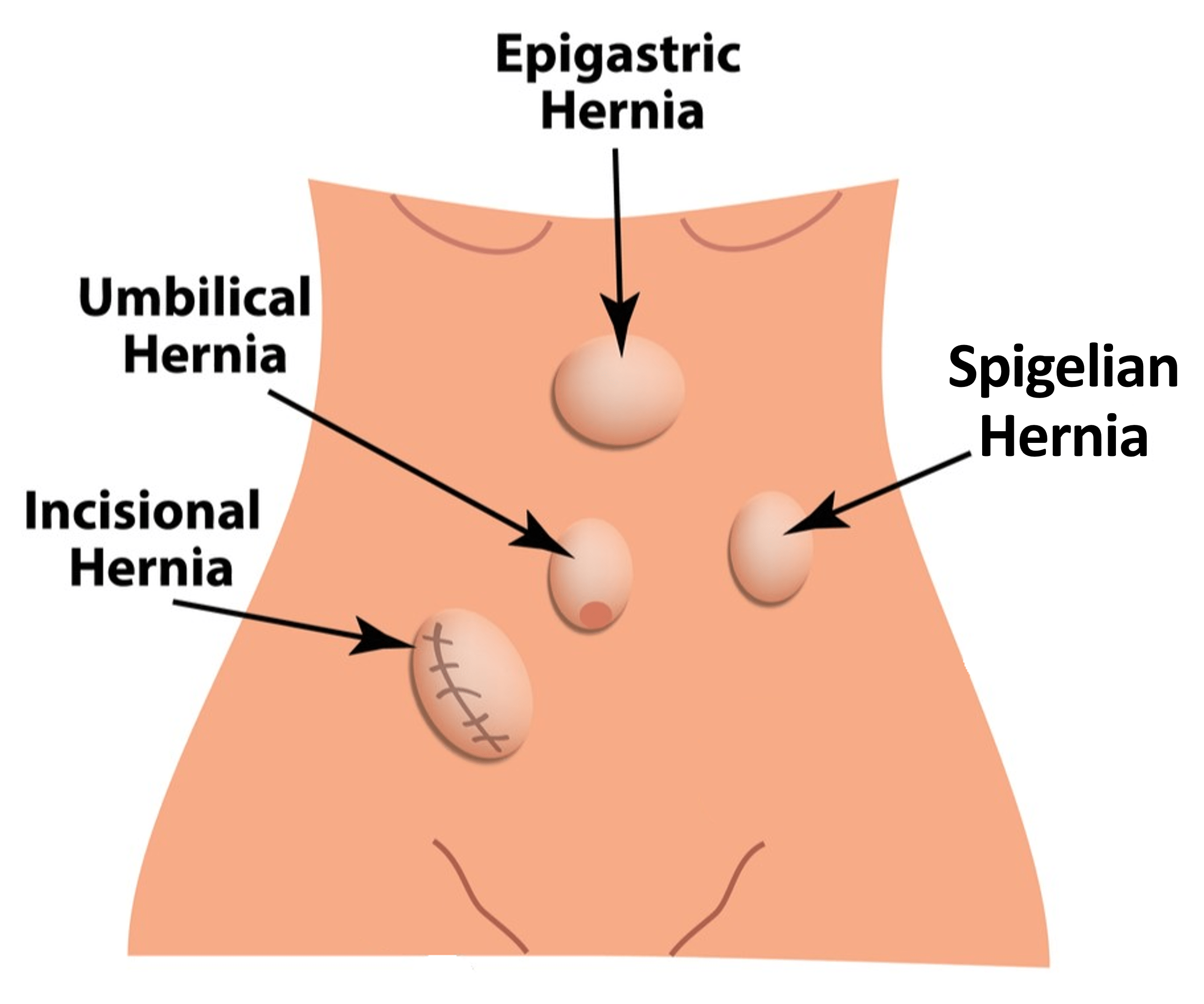 Illustration of the different types of ventral hernias and where on the abdomen they are located.