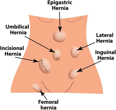 Stylised image showing different locations of hernias, as treated by the team at Hernia Clinic Hampshire