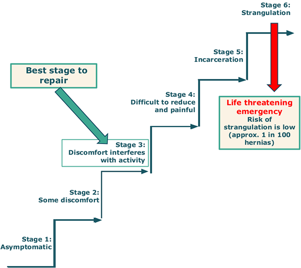 This diagram illustrates the 6 stages of a hernia, from Stage 1, where the hernia is asymptomatic through to the rare but life threatening, Stage 6, where emergency surgery is required. We recommend surgery at Stage 3.