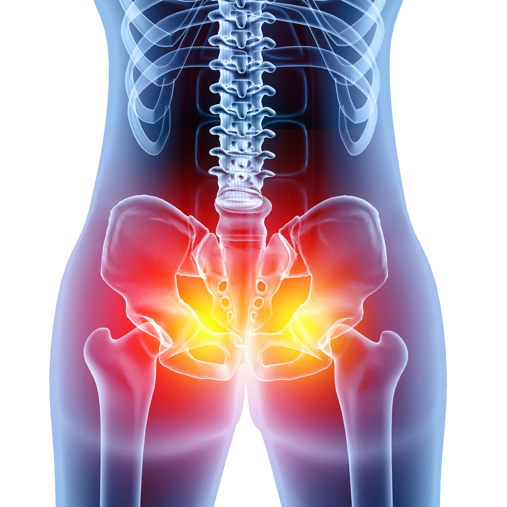 A graphic of a human pelvis with red and yellow light highlighting where sports hernia pain might be felt.