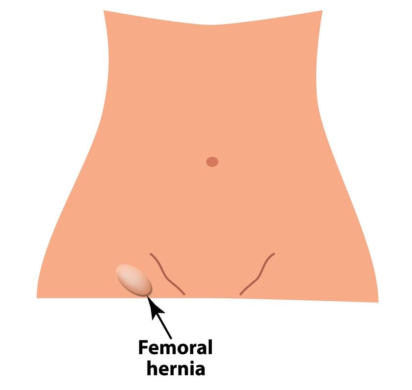 Illustration showing where femoral hernias are located.