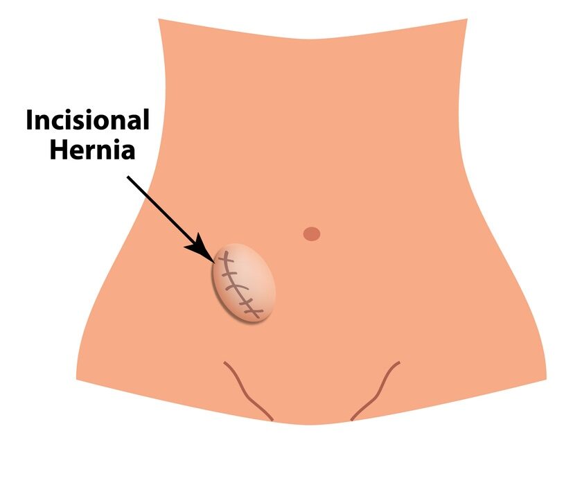 Illustration showing where incisional hernias are located.