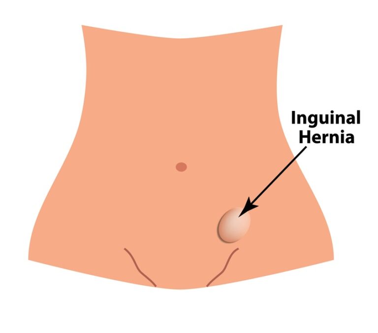 Illustration showing where inguinal hernias are located.