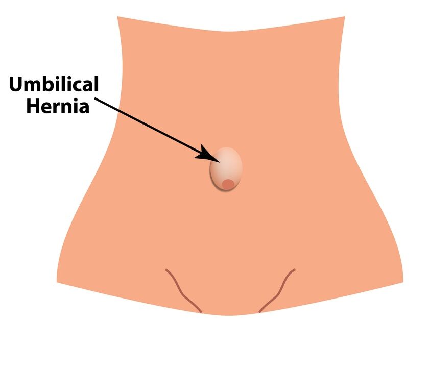 Illustration showing where umbilical hernias are located.