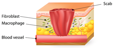 Image 2 of 4 representing the four stages of wound healing - inflammatory