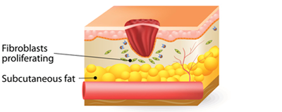 Image 3 of 4 representing the four stages of wound healing - proliferative
